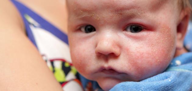 Tips for dealing with eczema in children